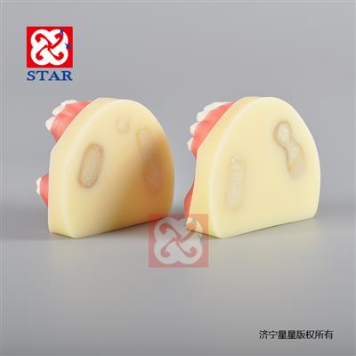 全口定位缺失區種植縫合練習