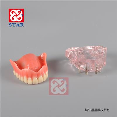 4個微型種植釘，上頜一尺修復。M6001